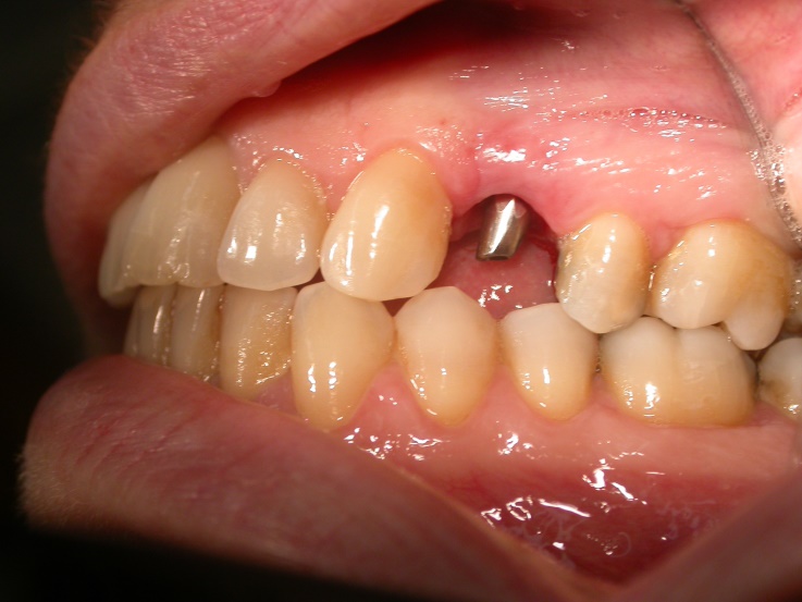 impianto-dentale-prima