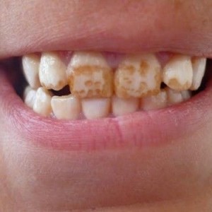 fluorosi dentale